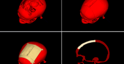 Австрийские исследователи разработали бесплатное программное обеспечение для автоматизированного проектирования  3D-печатаемых черепных имплантатов