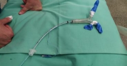Операция на лёгких для маленькой девочки в Израиле была проведена с помощью 3D-печати