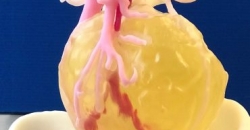 Напечатанная в 3D модель опухоли привела к выздоровлению пациента
