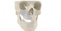 Челюстно-лицевой трансплантат MyBone, напечатанный в 3D, одобрен для установки пациентами в Европе