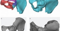 Исследователи полагают, что 3D-печать более эффективна при лечении переломов бедра