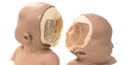 Анатомические модели, напечатные LMI 3D помогли хирургам разделить сиамских близнецов
